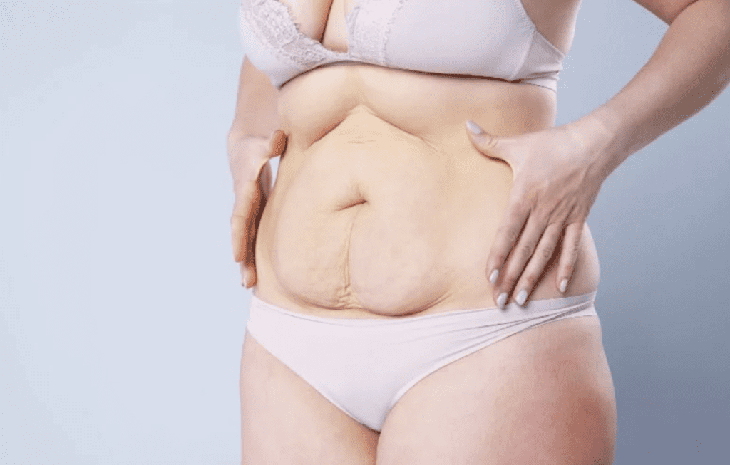 Ultimate Tummy Tuck in Dubai: Style and Confidence 2 Tummy Tuck in Dubai