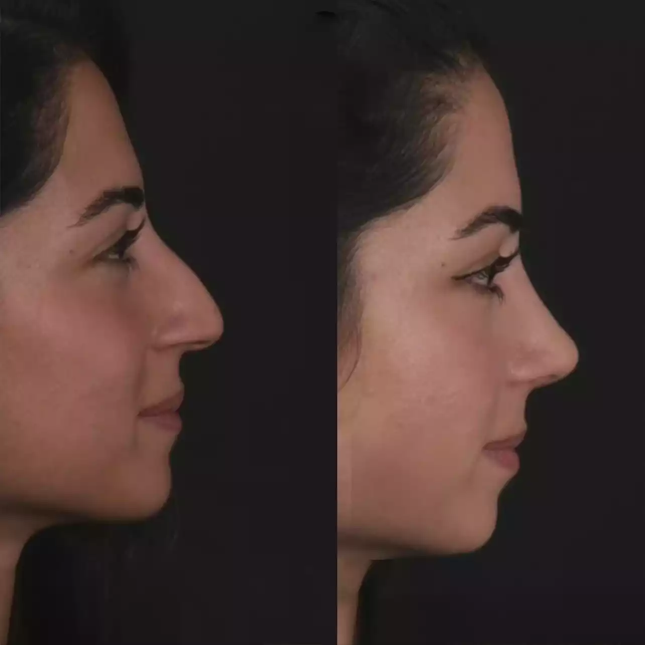 septoplasty in Dubai