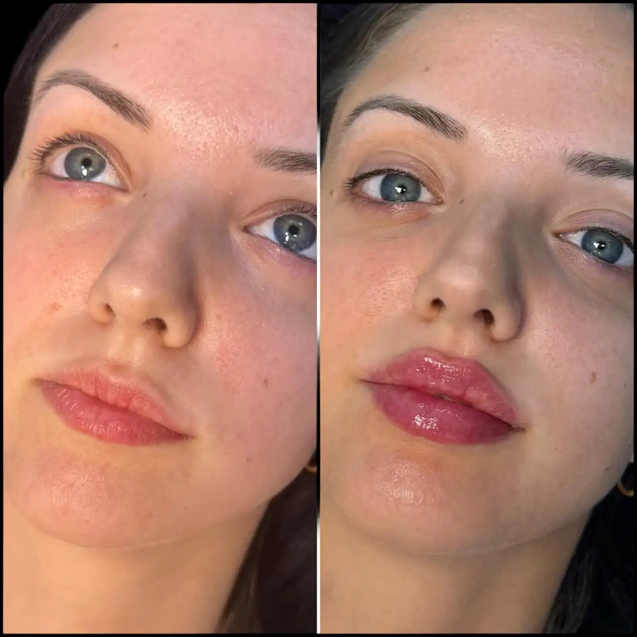 H5 lip fillers 1 1