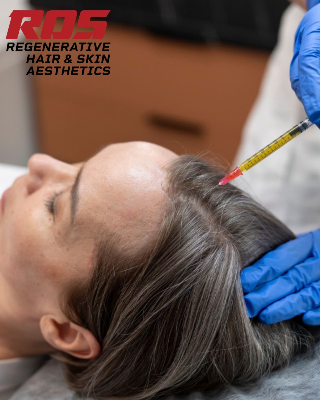 stem cell therapy for hair transplant