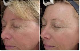 Cool Beam Laser Skin Resurfacing