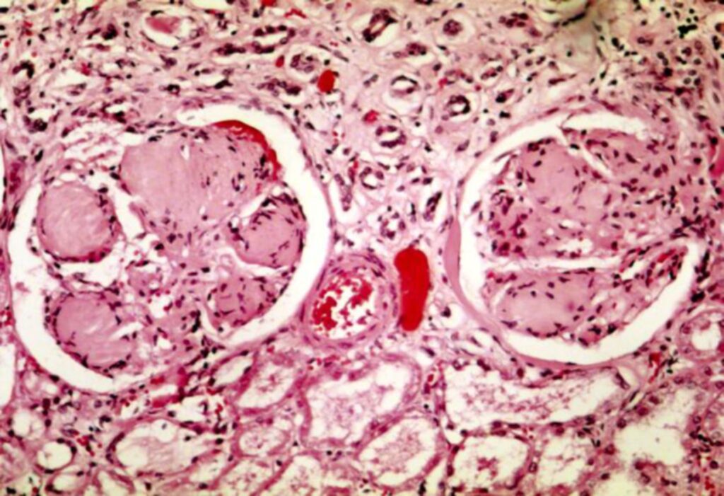 Understanding Infantile Nephrotic Syndrome Causes, IgAN Causes, and Nephrotic Syndrome Causes – NephCure Provides Insights 2 C1q Nephropathy Symptoms image 1
