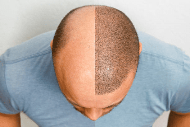 Hair Transplant in Riyadh: Answers to All Your Questions 2 Hair Transplant in Riyadh 3