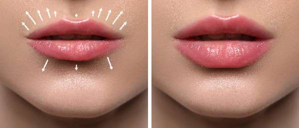 Maintain a Radiant, Youthful Glow with Natural Adjustments in Richmond 3 Lip Filler