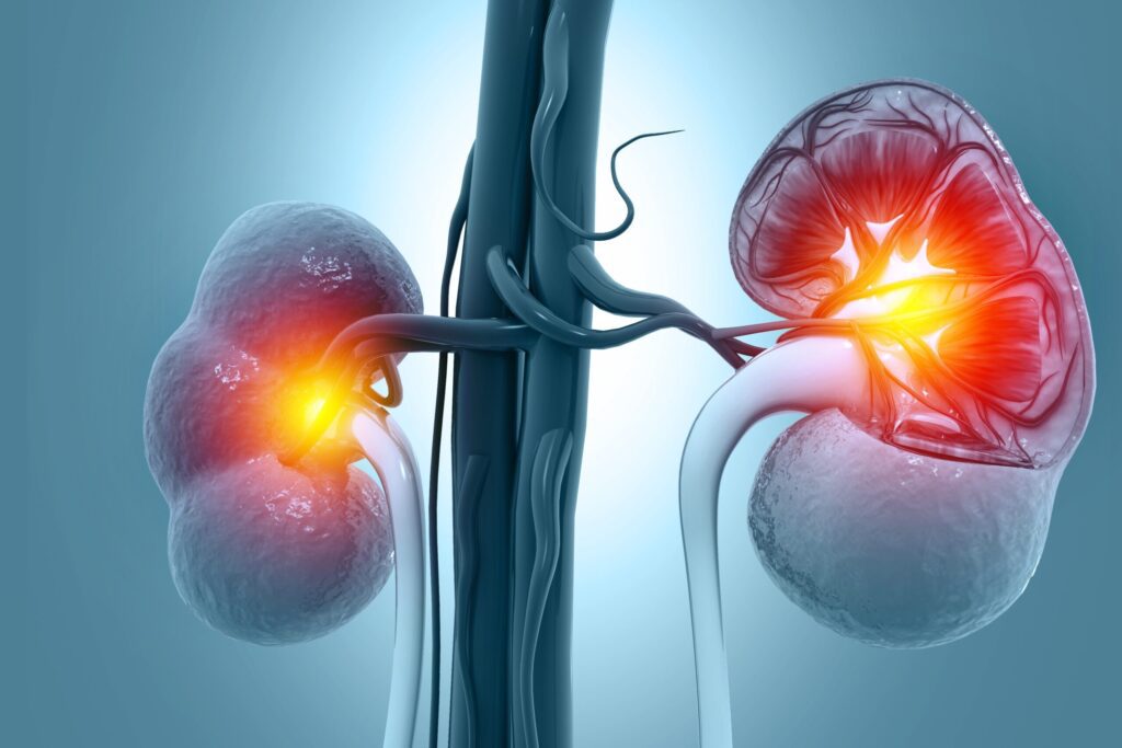 Understanding Infantile Nephrotic Syndrome Causes, IgAN Causes, and Nephrotic Syndrome Causes – NephCure Provides Insights 1 MicrosoftTeams image379361bf8c3e63336b2b7ad77a916c2ad2df59fe6c273d824a34ec1983658b0c scaled 1