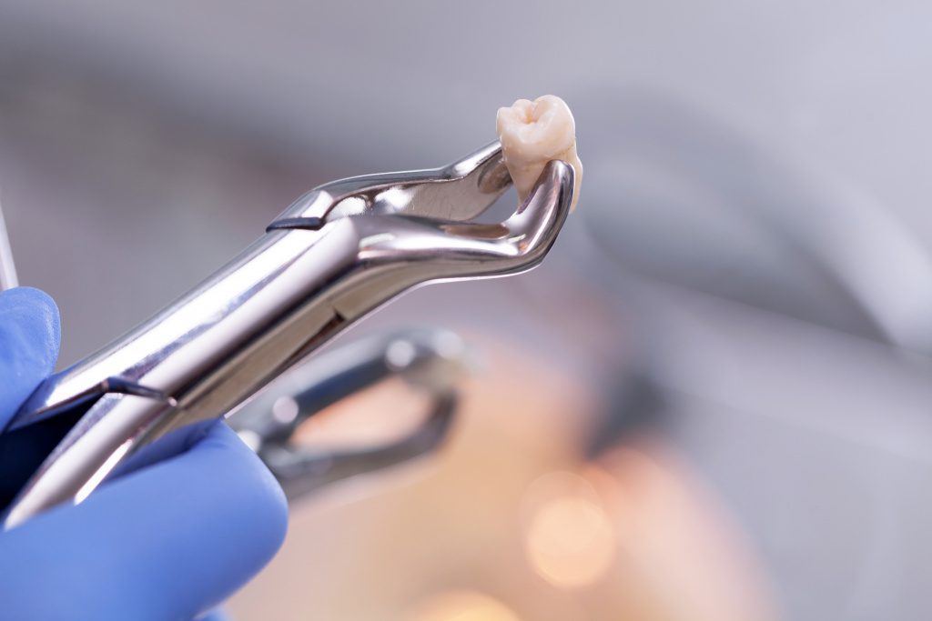 Tooth extraction Bakersfield image-2