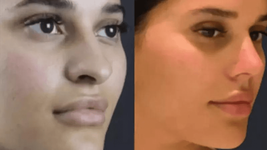 nose surgey in dubai