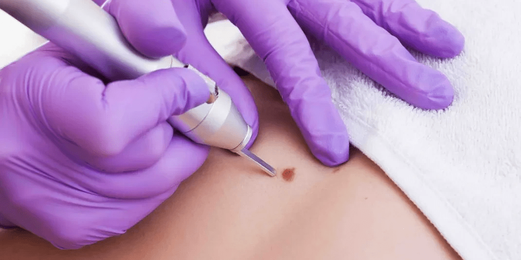 how long does wart removal take to heal