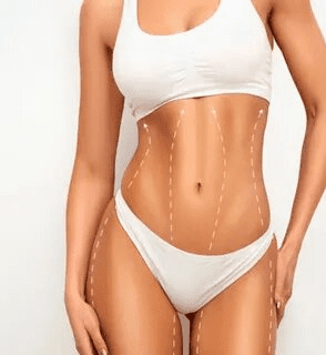 J Plasma Lipo in NYC – Advanced Body Contouring with J Plasma
