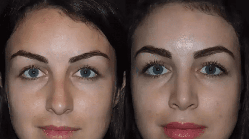 rhinoplasty-in-dubai-
